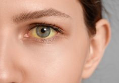 Jakie są przyczyny żółtych oczu?