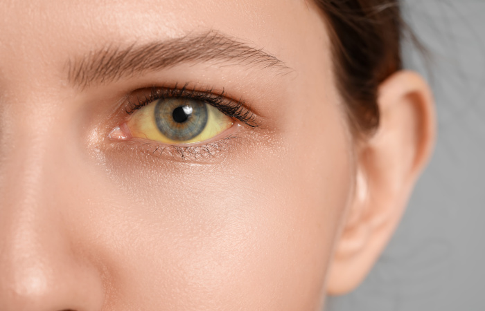 przyczyny żółtych oczu